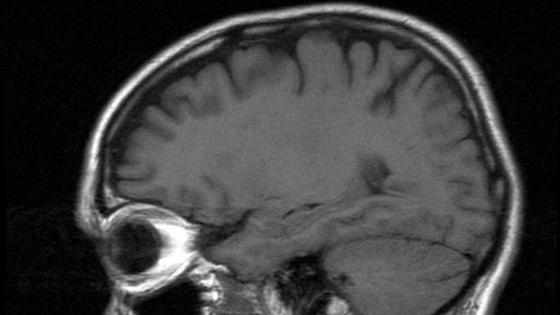 Wstrząśnienie mózgu: uszkodzenia mogą być widoczne 4 miesiące później